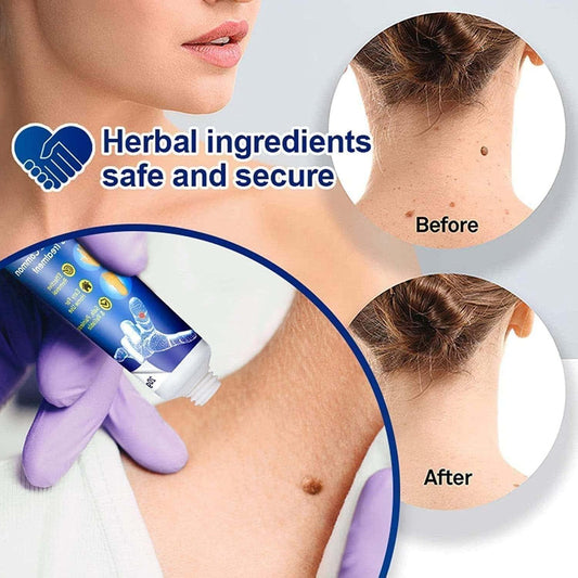 WartsOff Instant Blemish Removal Cream All Skin Types - Star Deal Treasure
