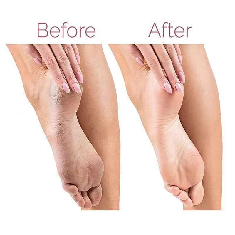 Electric Pedicure Foot File – Rechargeable Callus Remover for Smooth Feet