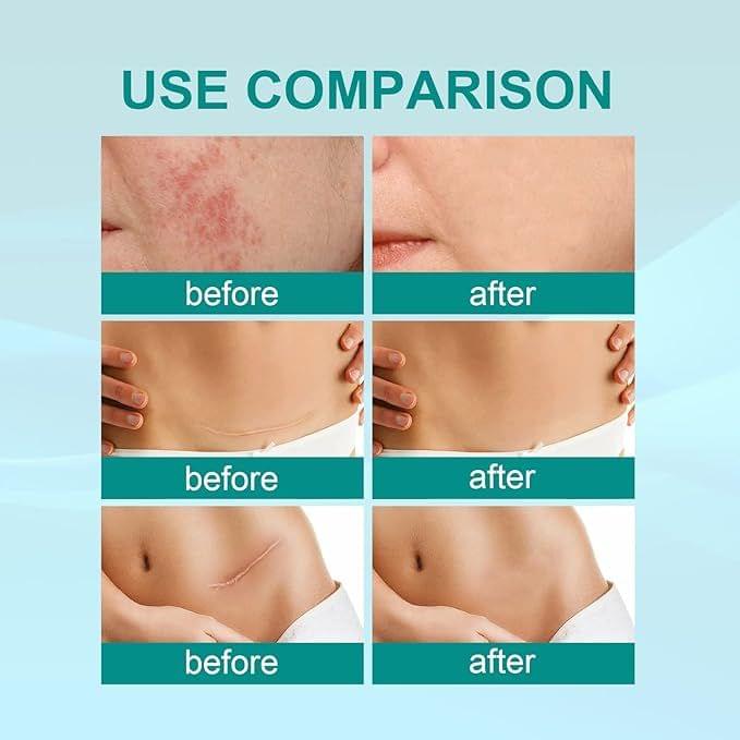 Medical Scar Removal Spray - Star Deal Treasure