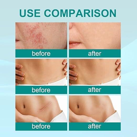 Medical Scar Removal Spray - Star Deal Treasure