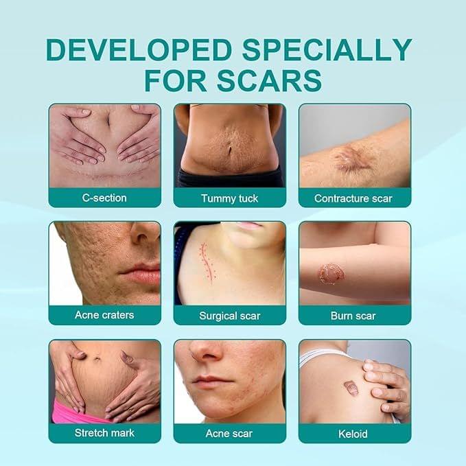 Medical Scar Removal Spray - Star Deal Treasure